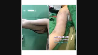 جراحی لیفت بازو