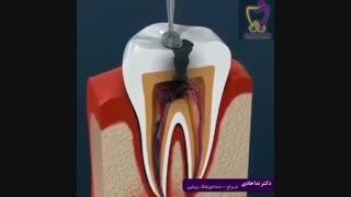 فیلم عصب کشی دندان
