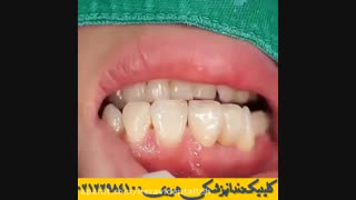 کاربرد پل دندان در دندانپزشکی | نصب بریج دندان توسط دندانپزشک