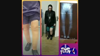 فحص المریضه بعد شهر من عملیه الرکبه المقوسه