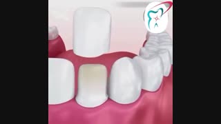 درمان زیبایی لمینت دندان