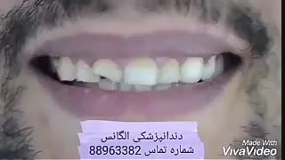 قیمت روکش زیرکونیا | بهترین متخصص ونیر کامپوزیت | قیمت سفید کردن دندان