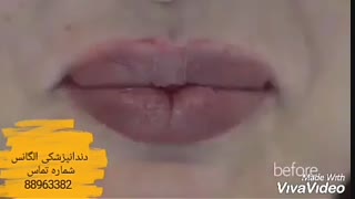 فیلم بریج دندان | فلوراید تراپی | مراحل فلوراید تراپی | بهترین متخصص اندو | بهترین متخصص عصب کشی میدان ولیعصر