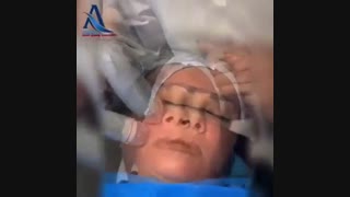 آر اف فراکشنال برای جوانسازی پوست برداشتن خال