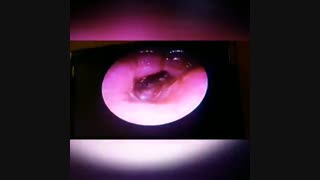 آندوسکوپی حنجره در بیمار مبتلا به سرطان حنجره