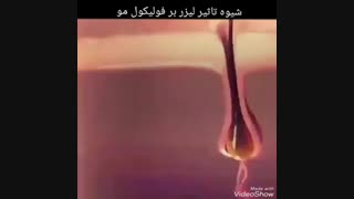 شیوه تاثیر لیزر بر فولیکول مو ترمیم سوختگی