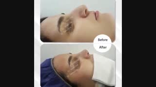 نمونه جراحی بینی دکتر علی طاهری نیا اصلاح فرم صورت