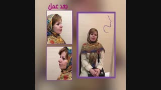 عمل زیبایی بینی