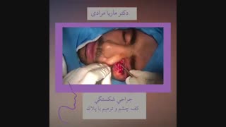 جراحی شکستگی کف چشم