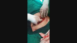 میوم در خانم جوان ۳۷ ساله