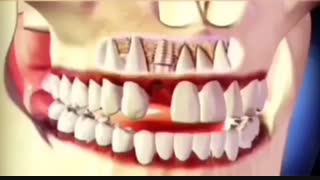 ایملنت برای دندان از دست رفته