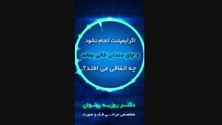 ضرورت انجام ایمپلنت دندان