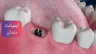 ایمپلنت دندان جلو