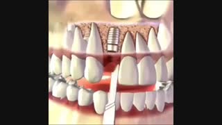 ایمپلنت دندان بدون درد