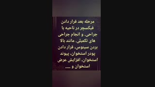 مراحل ایمپلنت دندان