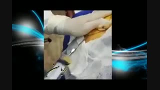 فیلم کشیدن چربی | کلینیک آریامن 02142485000