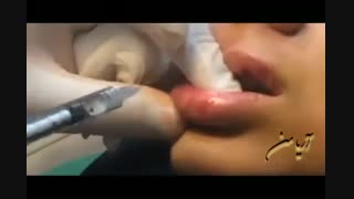 مراحل تزریق ژل لب | کلینیک زیبایی آریامن | 02141608