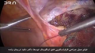 فیلم جراحی لاپاراسکوپی فتق اینگوینال توسط دکتر داود نریمان زاده ارتودنسی