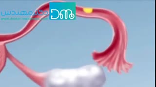 بارداری خارج از رحم