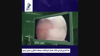 فیلم عمل جراحی ترمیم رباط صلیبی و منیسک زانو