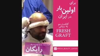 کاشت مو با روش Fresh Graft