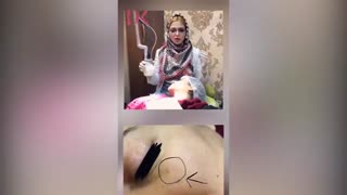 فیلم برداشتن خال با لیزر