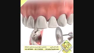 مثلث سیاه بین دندان ها | دکتر لادن طیبی