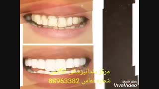 مراحل سفید کردن دندان| مزایای بلیچینگ دندان | معایب بلیچینگ دندان | فیلم ایمپلنت کردن دندان درمان سلولیت