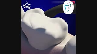 برداشت پوسیدگی و ترمیم همرنگ دندان