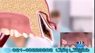 ویدیویی کوتاه درباره عفونت دندان و آبسه دندان
