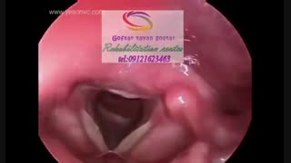 بهترین مرکز درمان حنجره در البرز 09121623463