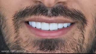 ونیر کامپوزیت  سوپر بلیچ فک بالا