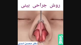 انیمیشن جراحی زیبایی بینی