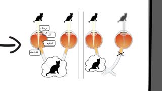 تنبلی چشم کودکان