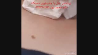 برداشتن خال با لیزر