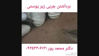 برداشتن زگیل و خال