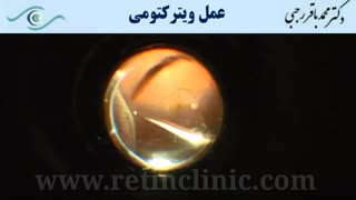 فیلم عمل ویترکتومی