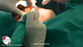 ایمپلنت دندان به روش DIOnavi