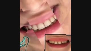 نمونه کارهای دکتر لیلا صدقی جراحی لثه