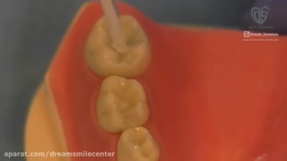 فیشور سیلانت دندان کودکان