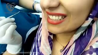 لیفت لثه با لیزر