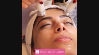 لایه برداری و جوانسازی پوست با میکرودرم