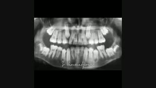 مراحل باز کردن فضا جهت رویش دندانهای نیش نهفته | دکتر همت پور