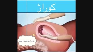 خارج کردن دستی جفت