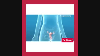 فیلم جراحی هیسترکتومی