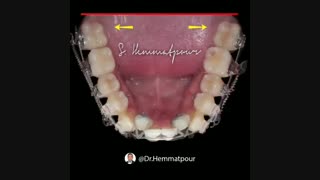 استفاده از فنرهای عمودی بازکننده و TAD system وMBT | دکتر سیامک همت پور لیفت پیشانی