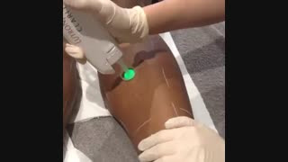 اجاره لیزر الکساندرایت کلاریتی