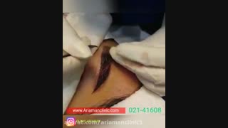 فیلم مراحل کاشت ابرو در کلینیک آریامن 02142485000
