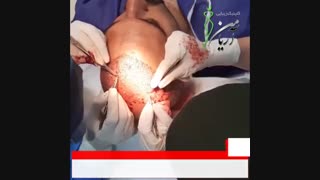 فیلم کاشت مو به روش SUT | کلینیک کاشت مو و زیبایی آریامن 02141608