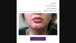 کم کردن خطوط اندوه